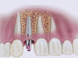 bursa implant